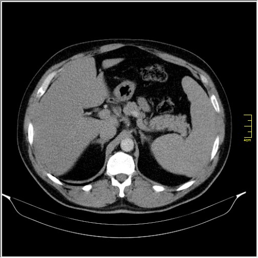 Acute right sided diverticulitis (Radiopaedia 65249-74268 Axial C+ portal venous phase 19).JPG