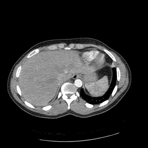Acute segmental pulmonary emboli and pulmonary infarction (Radiopaedia 62264-70444 Axial C+ CTPA 97).jpg
