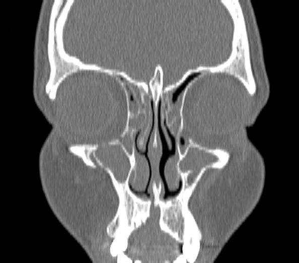 Acute sinusitis (Radiopaedia 40564-43158 Coronal bone window 9).jpg
