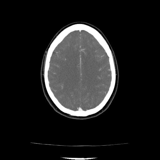 Acute subarachnoid hemorrhage and accessory anterior cerebral artery (Radiopaedia 69231-79009 Axial C+ arterial phase 109).jpg