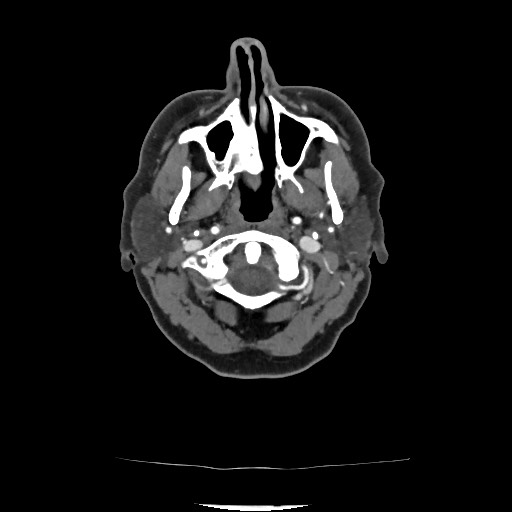 Acute subarachnoid hemorrhage and accessory anterior cerebral artery (Radiopaedia 69231-79009 Axial C+ arterial phase 71).jpg