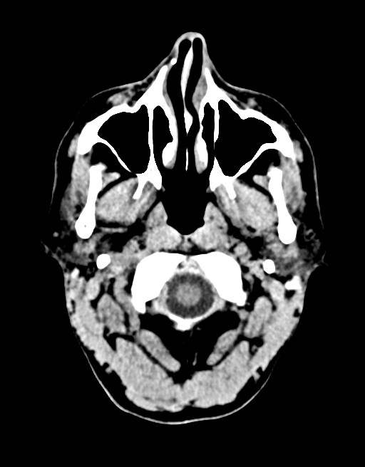 Acute superior cerebellar artery territory infarct (Radiopaedia 84104-99359 Axial non-contrast 64).jpg