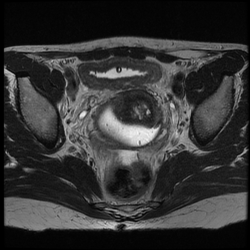 File:Adenocarcinoma arising in a urethral diverticulum (Radiopaedia 12400-12657 Axial T2 6).jpg
