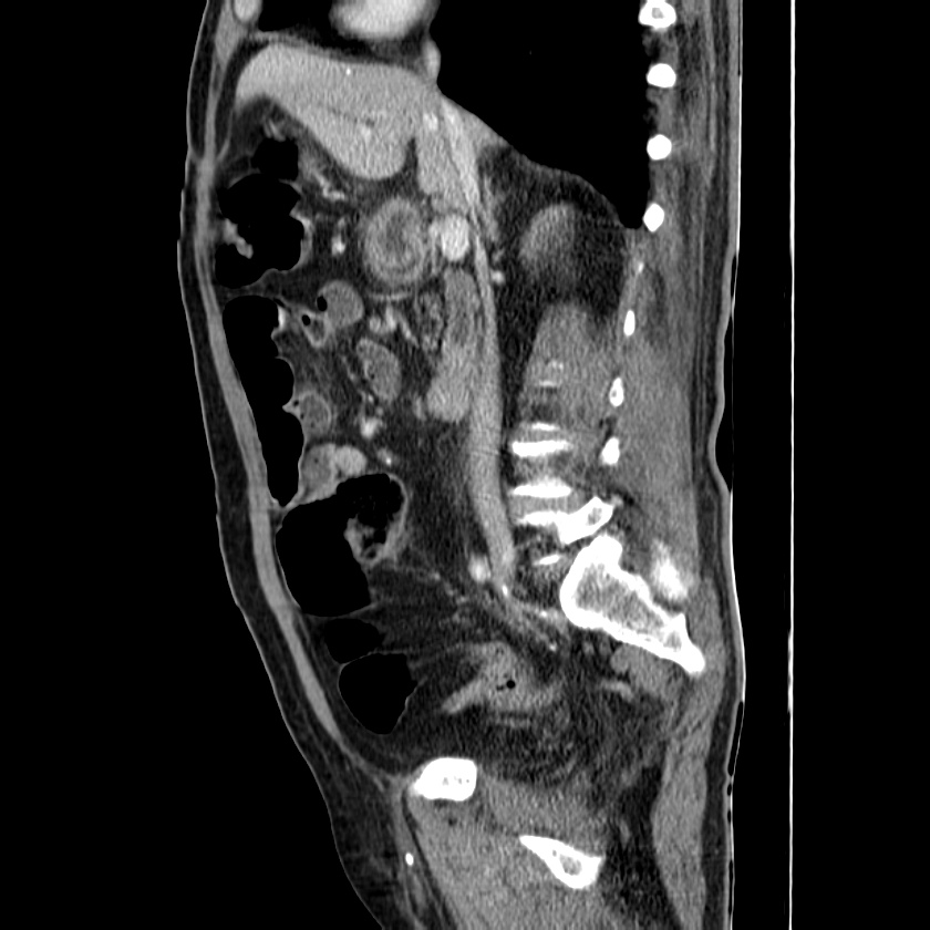 Adenocarcinoma of colon with entero-colic fistula (Radiopaedia 22832-22852 Sagittal C+ portal venous phase 27).jpg