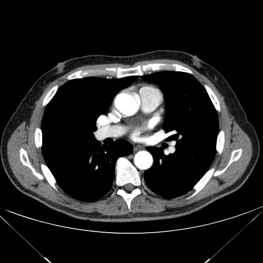 Adenocarcinoma of the lung (Radiopaedia 59871-67325 Axial C+ arterial phase 47).jpg