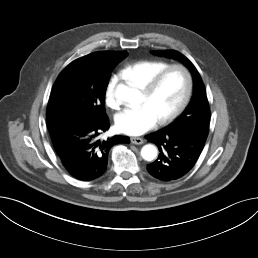 Adenocarcioma of rectum- T1 lesion (Radiopaedia 36921-38547 Axial C+ arterial phase 34).png