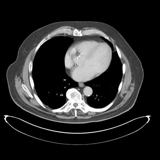 Adenocarcioma of rectum- T1 lesion (Radiopaedia 36921-38547 Axial C+ portal venous phase 5).png
