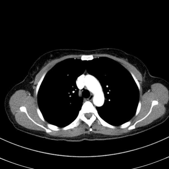 Adenocystic carcinoma of the trachea (Radiopaedia 47677-52525 Axial C+ arterial phase 43).jpg