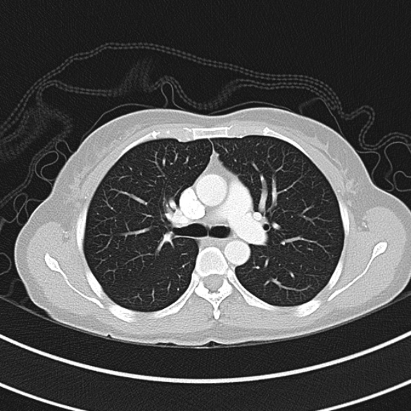 Adenocystic carcinoma of the trachea (Radiopaedia 47677-52525 Axial lung window 47).jpg