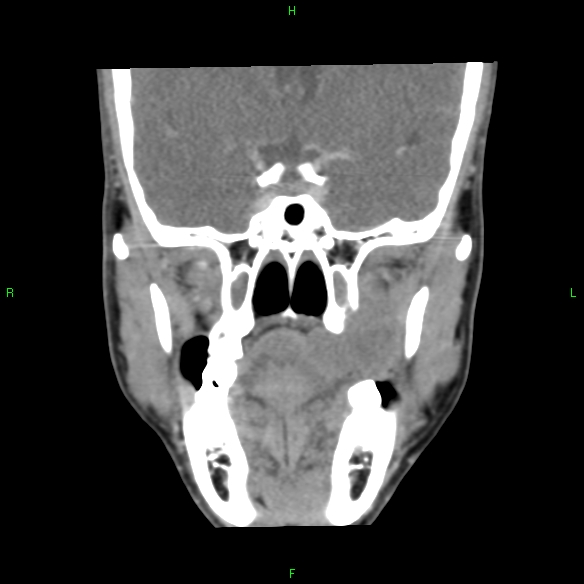 File:Adenoid cystic carcinoma of hard palate (Radiopaedia 26137-26273 Coronal liver window 15).jpg