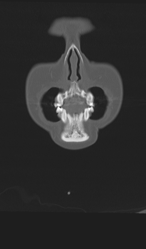 Adenoid cystic tumor of palate (Radiopaedia 46980-51518 Coronal bone window 11).png