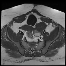 File:Adenomyosis within a didelphys uterus (Radiopaedia 70175-80215 Axial T1 20).jpg
