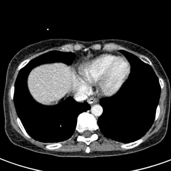 Adhesional small bowel obstruction (Radiopaedia 48397-53305 Axial C+ portal venous phase 2).jpg
