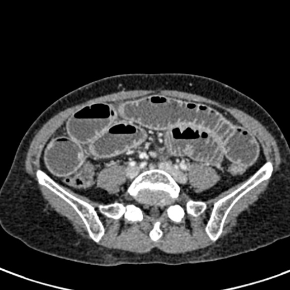 File:Adhesional small bowel obstruction (Radiopaedia 48397-53305 Axial C+ portal venous phase 60).jpg