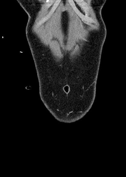 Adhesional small bowel obstruction (Radiopaedia 48397-53305 Coronal C+ portal venous phase 27).jpg