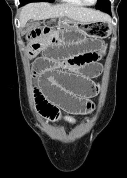 File:Adhesional small bowel obstruction (Radiopaedia 48397-53305 Coronal C+ portal venous phase 79).jpg
