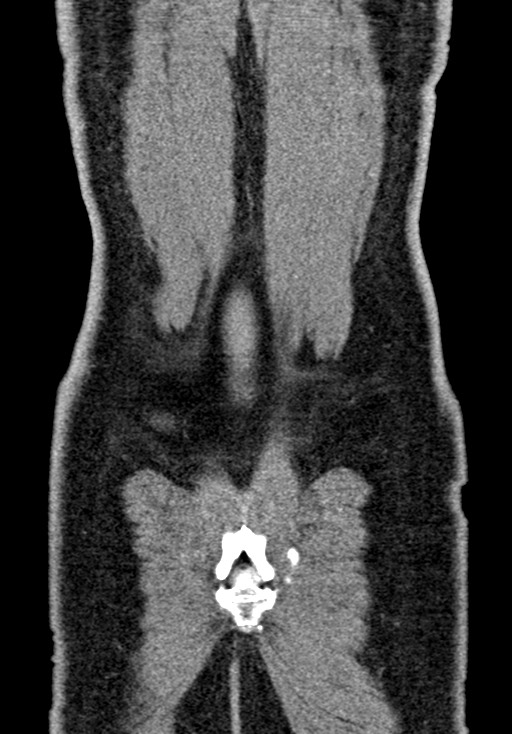 Adhesional small bowel obstruction (Radiopaedia 58900-66131 Coronal C+ portal venous phase 226).jpg