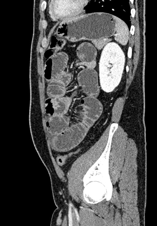 Adhesional small bowel obstruction (Radiopaedia 58900-66131 Sagittal C+ portal venous phase 188).jpg
