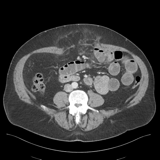 Adhesions within abdominal wall hernia (Radiopaedia 58283-65394 Axial C+ portal venous phase 49).png