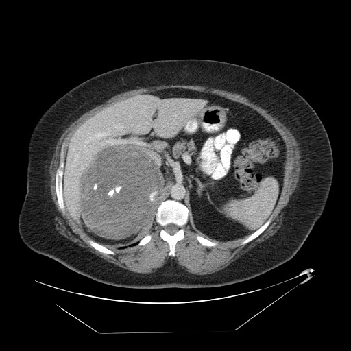 Adrenal angiosarcoma (Radiopaedia 81081-94671 Axial C+ portal venous phase 23).jpg