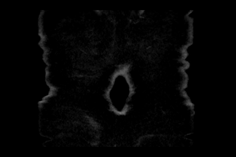 Adrenal cortical carcinoma (Radiopaedia 64017-72769 Coronal non-contrast 59).jpg