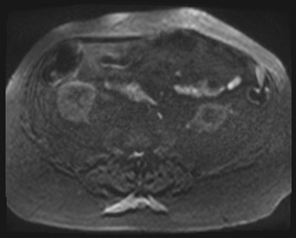 Adrenal cortical carcinoma (Radiopaedia 64017-72770 Axial DWI 121).jpg