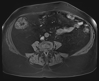 Adrenal cortical carcinoma (Radiopaedia 64017-72770 Axial T1 fat sat 66).jpg