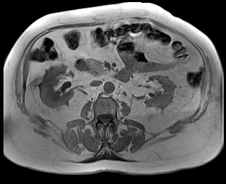 File:Adrenal cortical carcinoma (Radiopaedia 64017-72770 Axial T1 in-phase 45).jpg