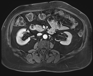 Adrenal cortical carcinoma (Radiopaedia 64017-72770 J 47).jpg