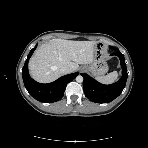 Adrenal cystic lymphangioma (Radiopaedia 83161-97534 Axial C+ portal venous phase 17).jpg
