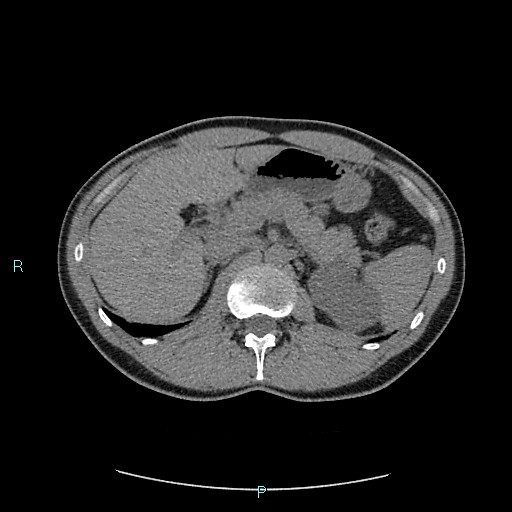 File:Adrenal cystic lymphangioma (Radiopaedia 83161-97534 Axial non-contrast 31).jpg