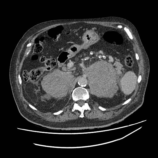 Adrenal lymphoma (Radiopaedia 84145-99415 Axial C+ portal venous phase 34).jpg