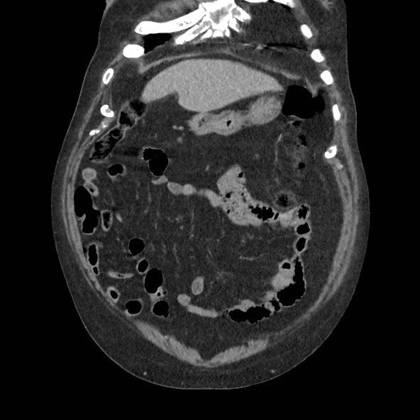 Adrenal lymphoma (Radiopaedia 84145-99415 Coronal C+ portal venous phase 16).jpg