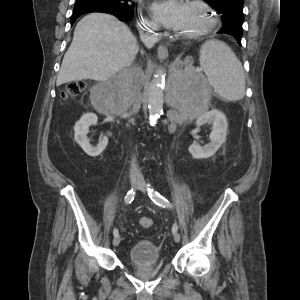 Adrenal lymphoma (Radiopaedia 84145-99415 Coronal C+ portal venous phase 48).jpg