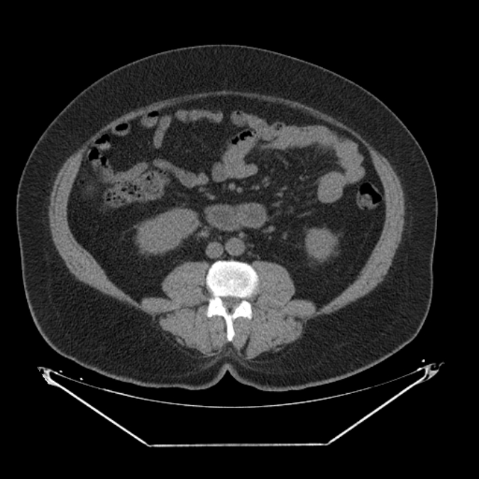 Adrenal myelolipoma (Radiopaedia 26278-26407 Axial non-contrast 38).jpg