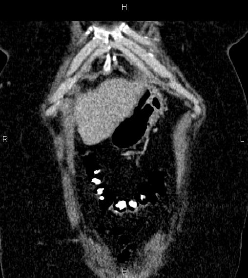 Adrenal myelolipoma (Radiopaedia 84319-99617 Coronal renal cortical phase 7).jpg
