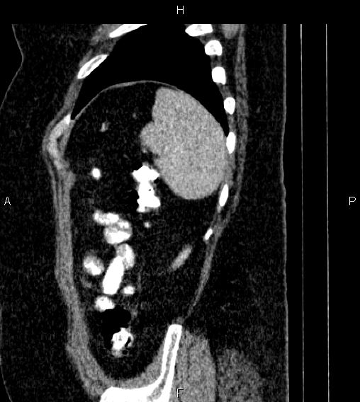 Adrenal myelolipoma (Radiopaedia 84319-99617 Sagittal renal cortical phase 84).jpg