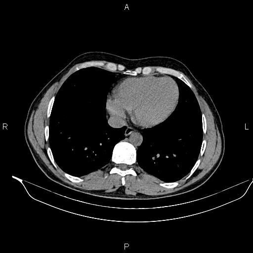 Adrenal myelolipoma (Radiopaedia 87794-104246 Axial non-contrast 9).jpg