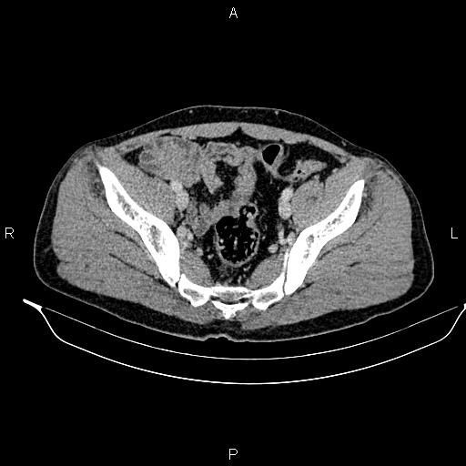 Adrenal myelolipoma (Radiopaedia 87794-104246 Axial renal cortical phase 89).jpg