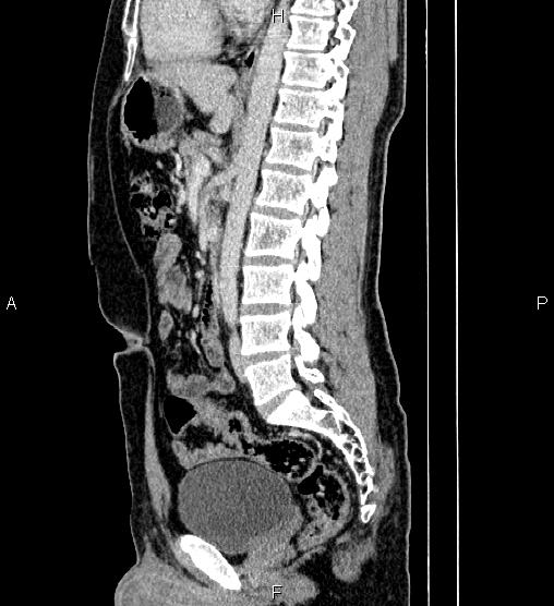 Adrenal myelolipoma (Radiopaedia 87794-104246 Sagittal renal cortical phase 51).jpg