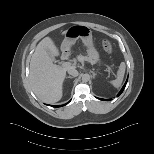 File:Adrenal vein sampling and adrenal nodular hyperplasia - Conn syndrome (Radiopaedia 30561-31337 Axial non-contrast 20).jpg
