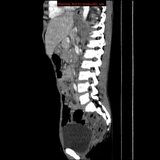 File:Adrenocortical carcinoma (Radiopaedia 9449-10131 Sagittal C+ portal venous phase 8).jpg