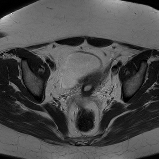 File:Adult granulosa cell tumor of the ovary (Radiopaedia 64991-73953 Axial T2 14).jpg