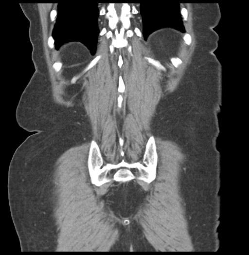 Adult ileal intussusception with secondary obstruction (Radiopaedia 30395-31051 Coronal C+ portal venous phase 54).jpg