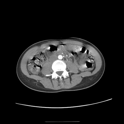 Adult polycystic kidney disease (Radiopaedia 48845-53876 Axial renal cortical phase 40).jpg