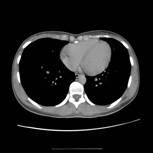 Adult polycystic kidney disease (Radiopaedia 48845-53876 Axial renal excretory phase 5).jpg