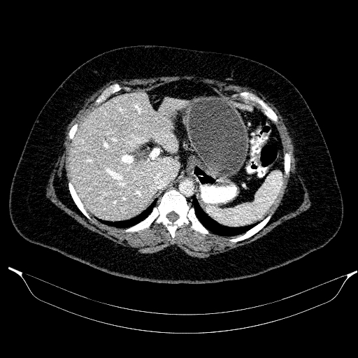 File:Afferent loop syndrome - secondary to incarcerated trocar site hernia (Radiopaedia 82959-97305 Axial C+ portal venous phase 55).jpg