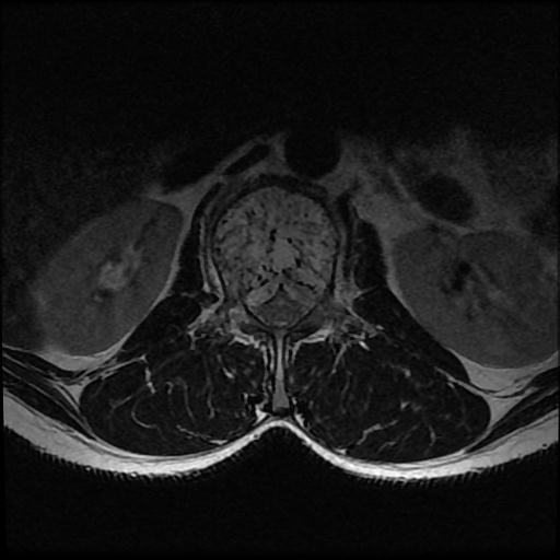 File:Aggressive vertebral hemangioma with pathological fracture (Radiopaedia 69528-79411 Axial T2 14).jpg