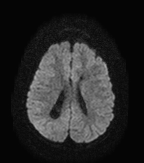 File:Aicardi syndrome (Radiopaedia 66029-75205 Axial DWI 15).jpg