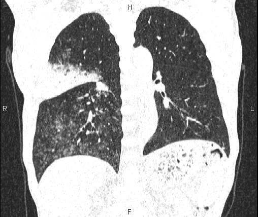 Air bronchogram in pneumonia (Radiopaedia 85719-101512 Coronal lung window 38).jpg